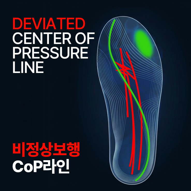 비정상 보행 CoP 라인 - 외측으로 이탈된 압력중심 경로
